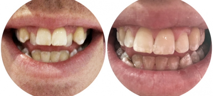 Lingual Braces in Ruislip  Teeth Straightening in Ruislip